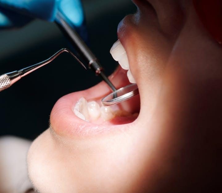 Bevar mundhygiejnen og undgå akutte tandlægesituationer